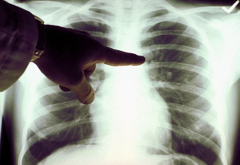 كيف تحسّن صحة جهازك التنفسي عند إصابتك بفيروس "كورونا" المستجد