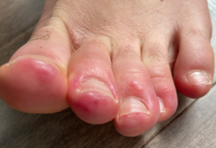 أعراض جديدة لكورونا تظهر في أصابع القدم