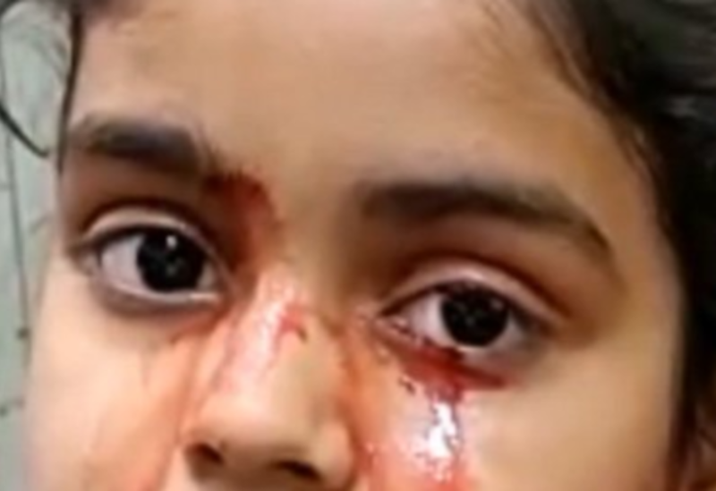 طفلة تبكي دما