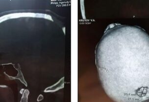 شرطي روسي يعيش برصاصة عالقة في جمجمته