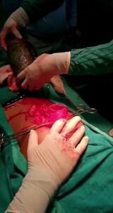 صورة لـ الشعر داخل معدة الفتاة