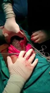 صورة لـ الشعر داخل معدة الفتاة