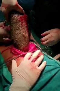 صورة لـ الشعر داخل معدة الفتاة