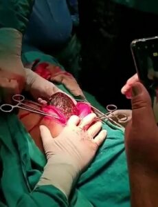 صورة لـ الشعر داخل معدة الفتاة
