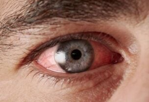 فحوص لتشخيص التهاب ملتحمة العين