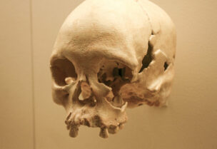 جمجمة تكشف عن عمل جراحي فاشل قبل 5 آلاف عام
