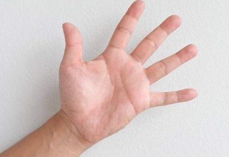 البقع الحمراء براحة اليد مؤشر خطير