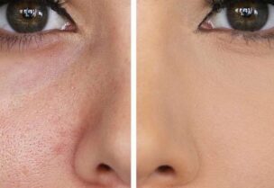 علاج مسامات الوجه الواسعة