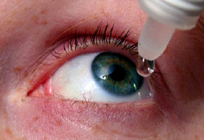 التهاب العين المزمن- تعبيرية