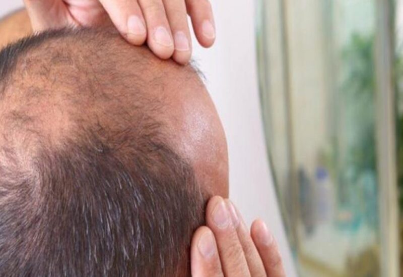 العامل الوراثي أبرز أسباب الصلع