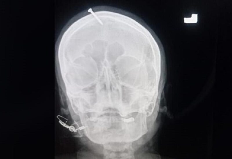 الصورة الاشعاعية تظهر المسمار في جبين المرأة
