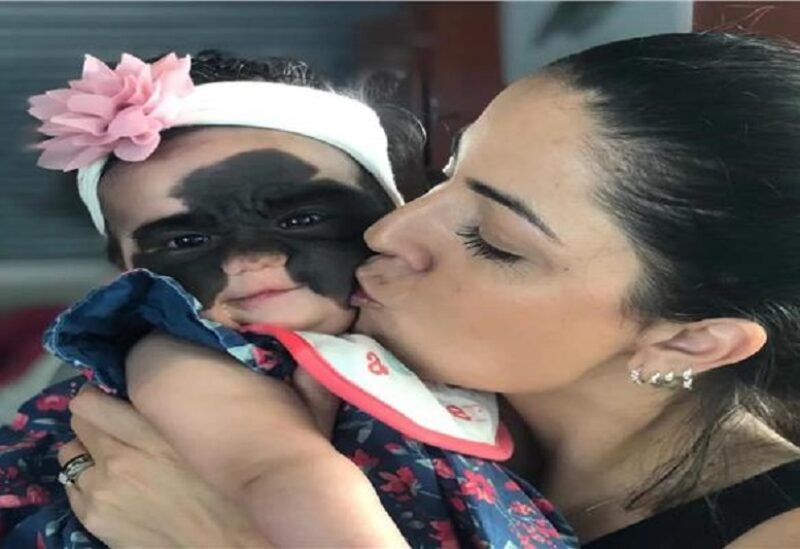 الطفلة لونا تافاريس فينير"وحمة باتمان"