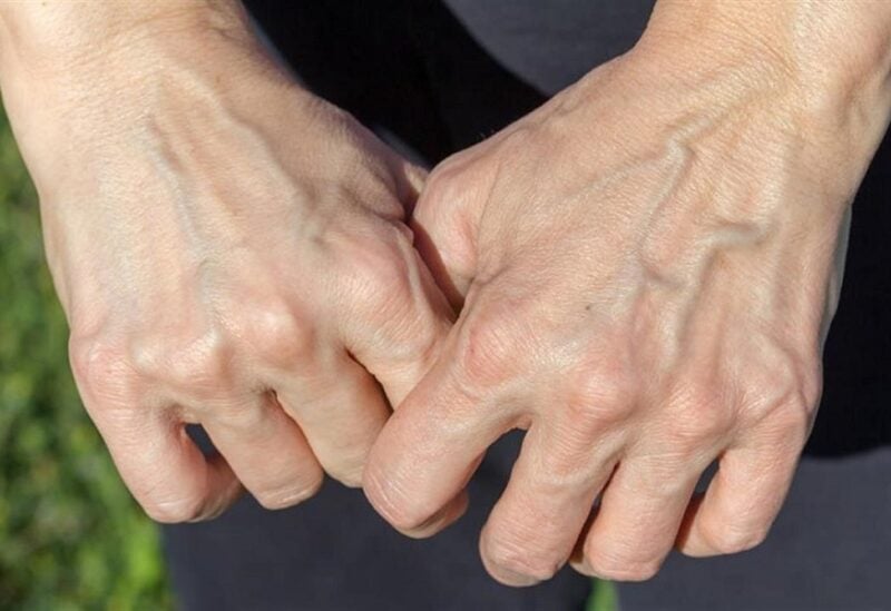 دهون اليدين تساعدة عادةً في تقليل ظهور عروق اليد