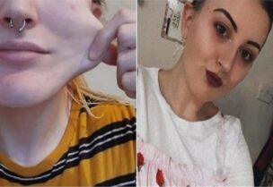 فتاة يتشقق جلدها وتتكسر عظامها