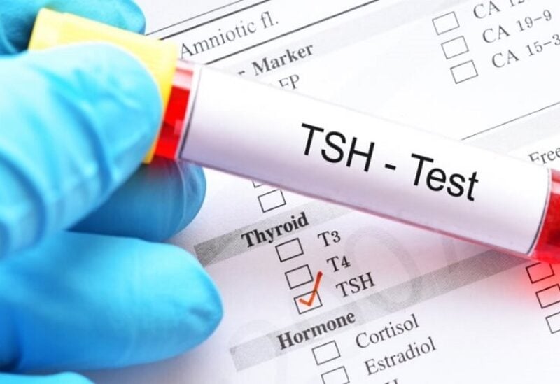 فحص الغدة الدرقية tsh