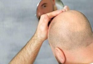 رجل أصلع- تعبيرية
