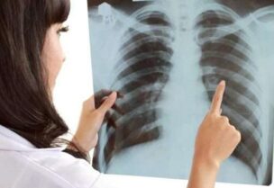 صورة أشعة للرئتين