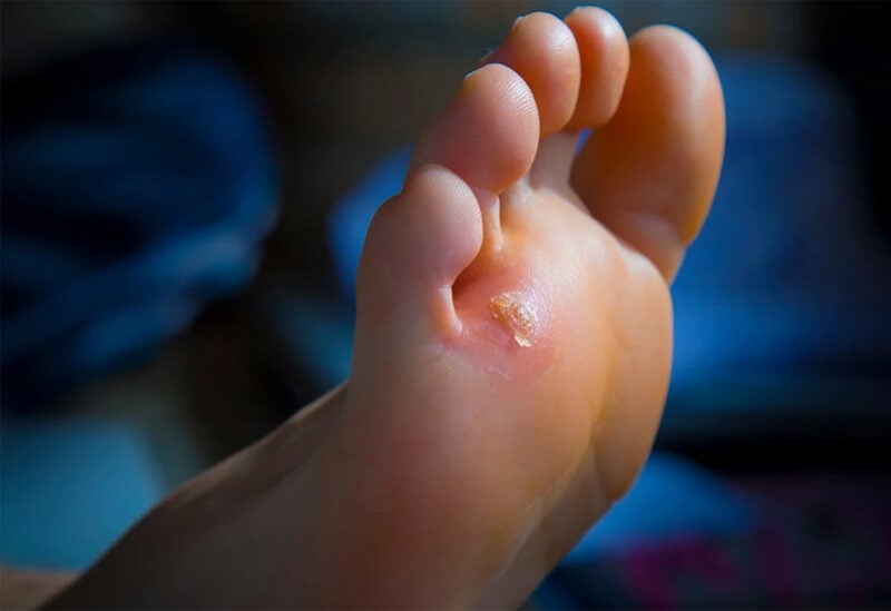مسمار اللحم عبارة عن نسيج أو بروز لحمي ينمو على قمم الأقدام وبين جوانب أصابع القدم