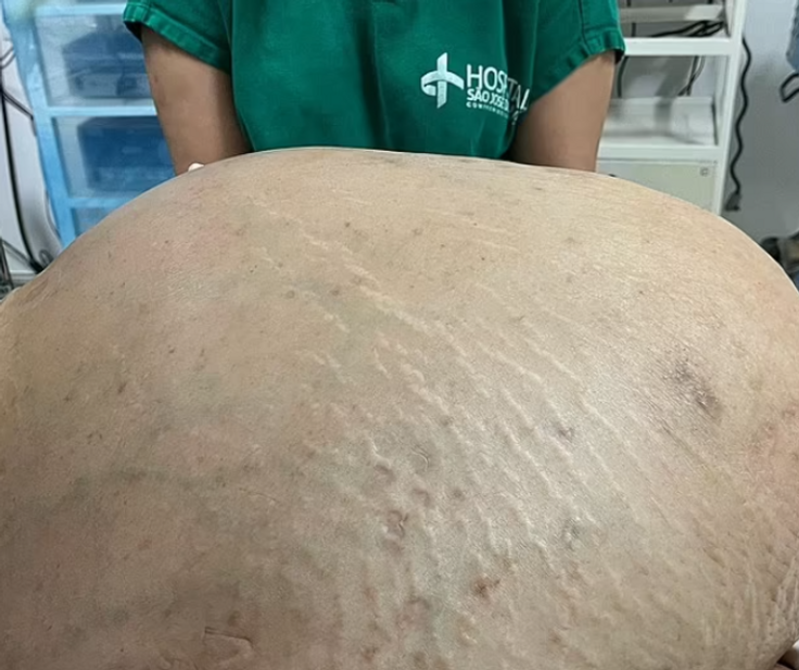 ورم في جسم امرأة