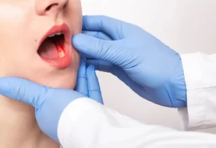 سرطان الفم- تعبيرية