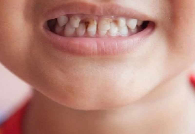 تسوس الاسنان عند الاطفال -تعبيرية