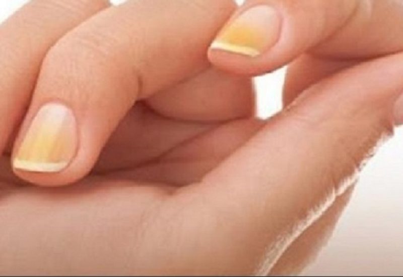 اصفرار الاضافر