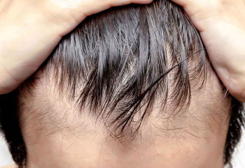 يتم زرع بصيلات شعر في نسيج ندبي