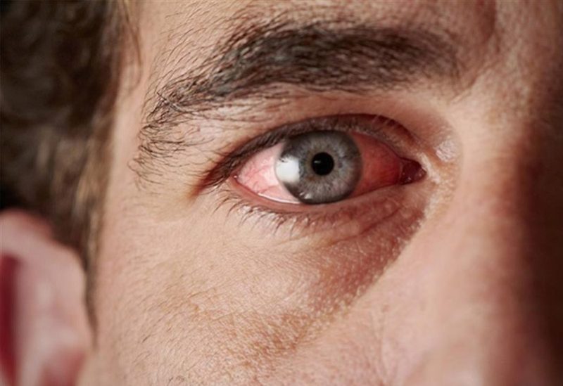 تزداد أعراض حساسية العين مع اقتراب فصل الصيف
