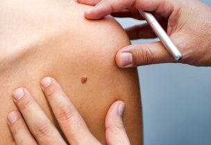 الشامة قد تكون من أعراض السرطان