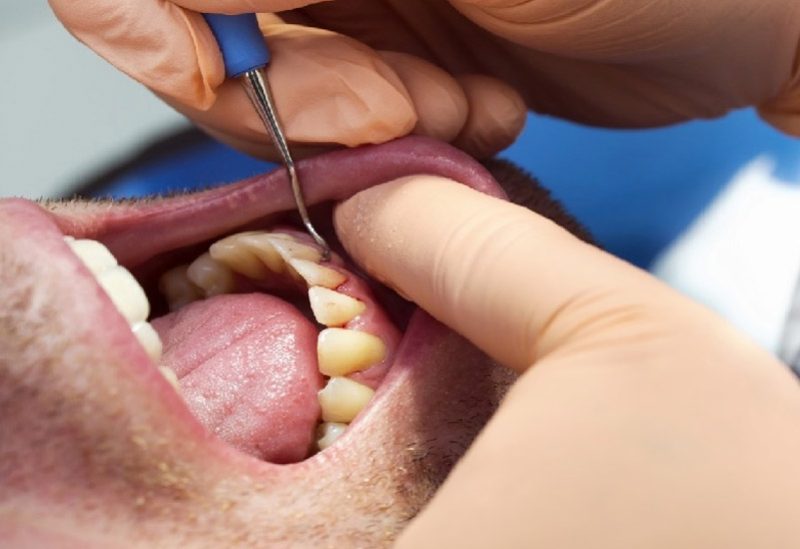 تعتبر مشاكل اللثة بوابة خطيرة لأمراض تهدد حياة الإنسان