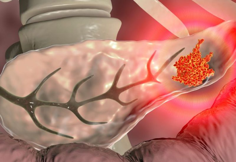 طب وصحة – إعلان علمي إسباني يبعث الأمل في علاج سرطان البنكرياس