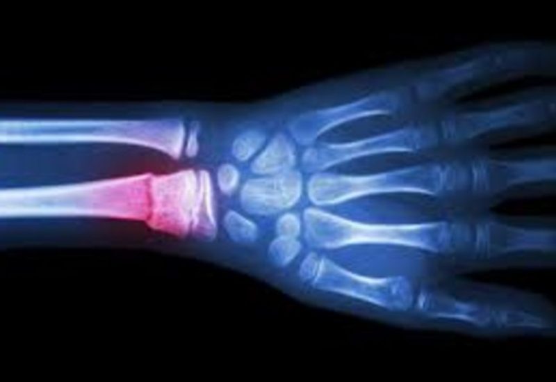 كسور العظام- تعبيرية