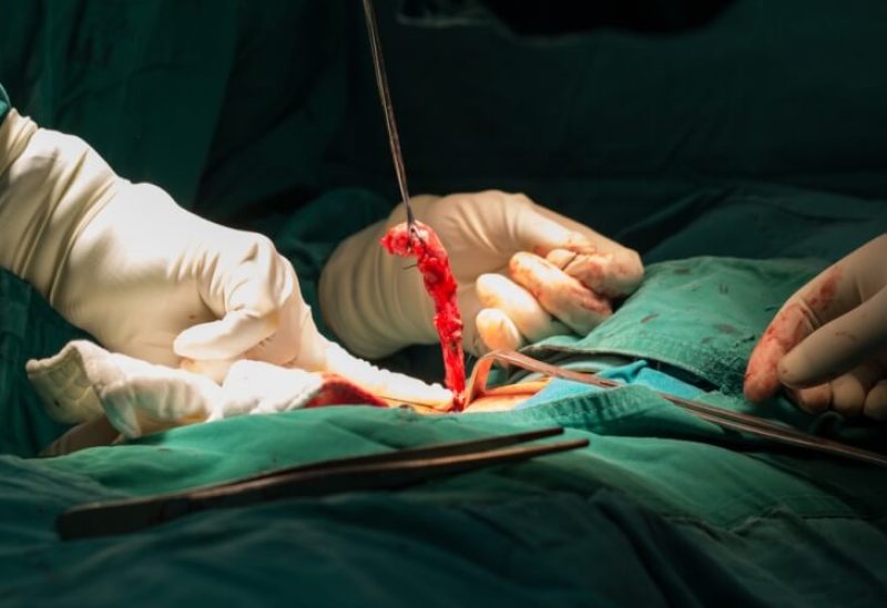 استئصال الزائدة الدودية - ويب طب