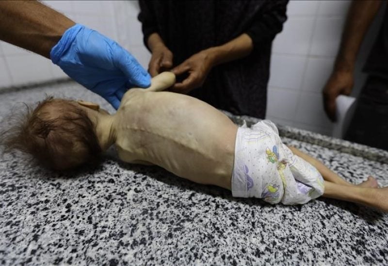 طفل في غزة يعاني من الجوع