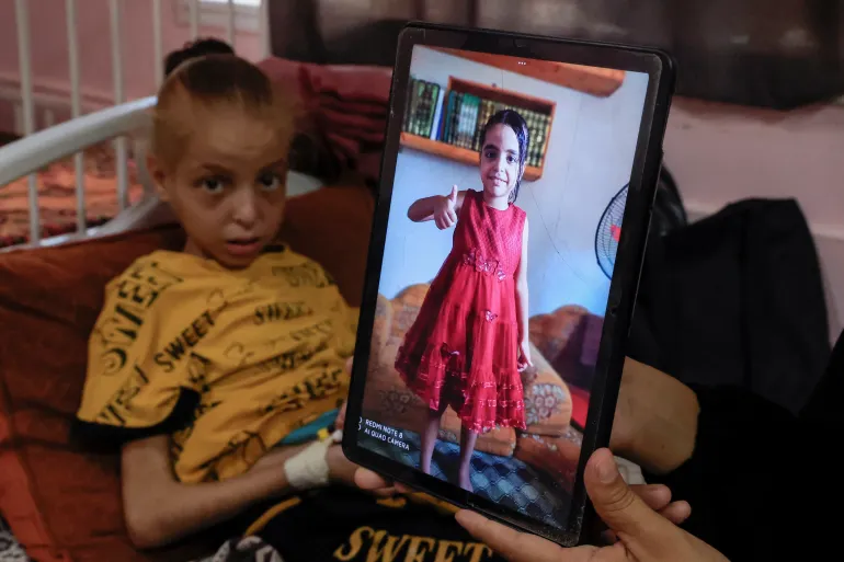 الطفلة هدى تتلقى العلاج داخل مجمع ناصر الطبي في خان يونس في صورة بتاريخ 5 أغسطس/آب الجاري (رويترز)