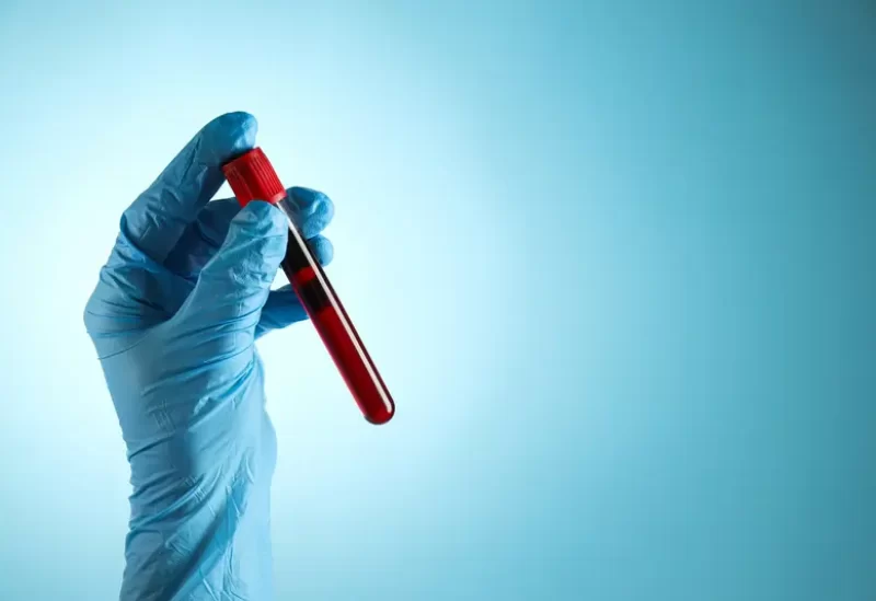 طب وصحة – قطرة دم تكشف الأورام المخفية باستخدام تقنية بصرية متقدمة